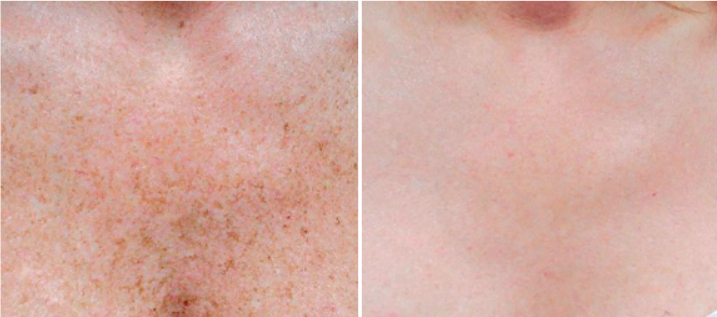 BROWN SPOTS BEFORE AND AFTER