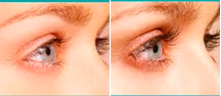 LATISSE BEFORE AND AFTER