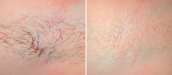 laser hair removal