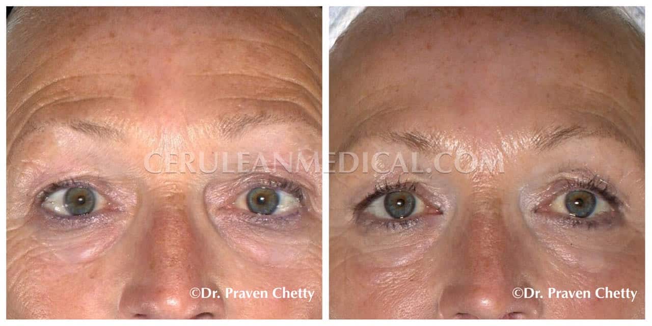 Forehead Botox Before and After Photo 4 at Cerulean Medical Institute in Kelowna BC