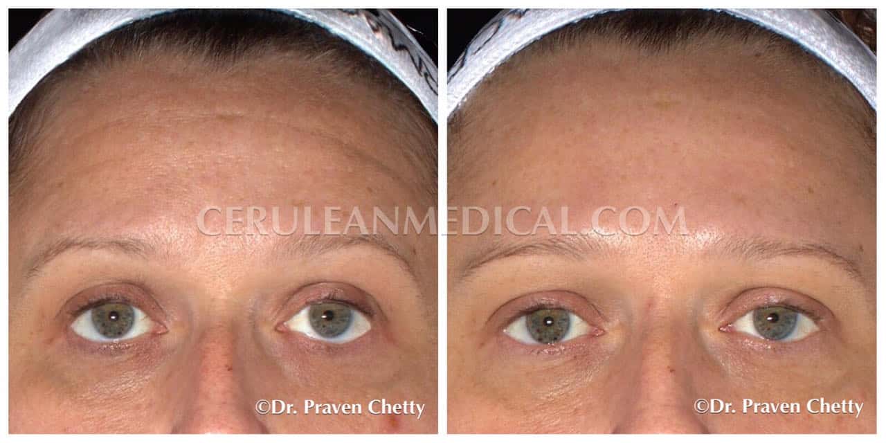 Forehead Botox Before and After Photo 2 at Cerulean Medical Institute in Kelowna BC