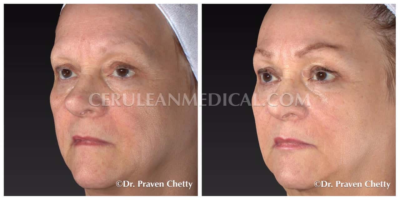 Dermal Fillers Before and After Photo 2 at Cerulean Medical Institute in Kelowna BC