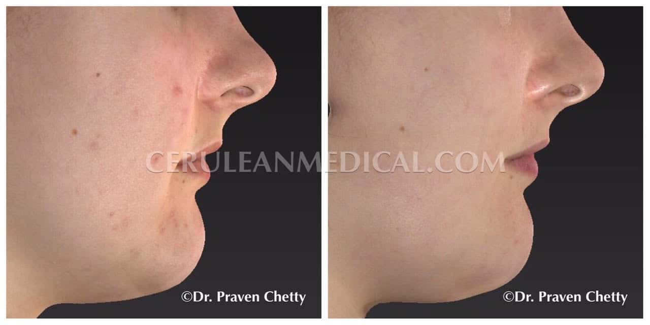 Acne Treatment Before and After Photo 2 at Cerulean Medical Institute in Kelowna BC