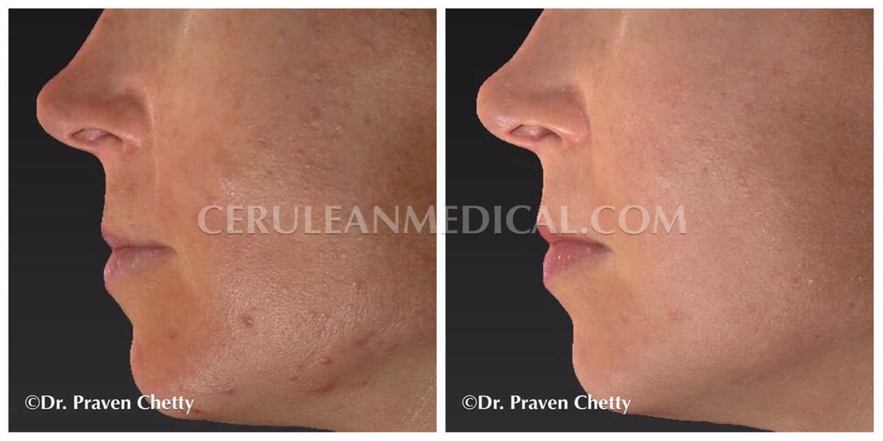 Acne Treatment Before and After Photo 3 at Cerulean Medical Institute in Kelowna BC