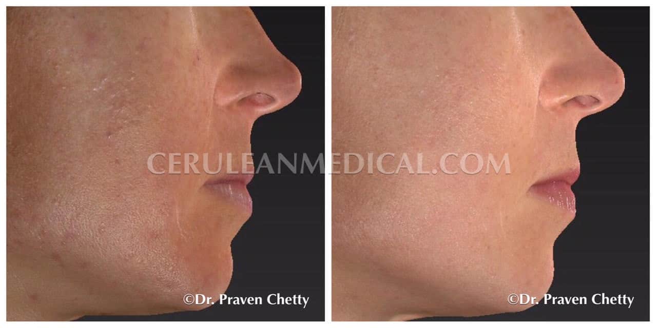 Acne Treatment Before and After Photo 4 at Cerulean Medical Institute in Kelowna BC