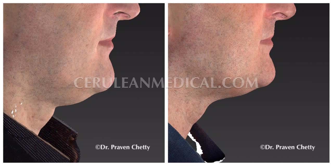 Belkyra Before & After Photo 1 at Cerulean Medical Institute in Kelowna BC