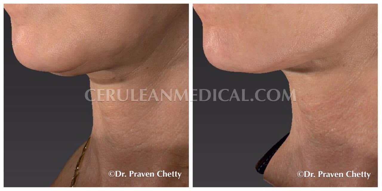 Belkyra Before and After Photo 2 at Cerulean Medical Institute in Kelowna BC