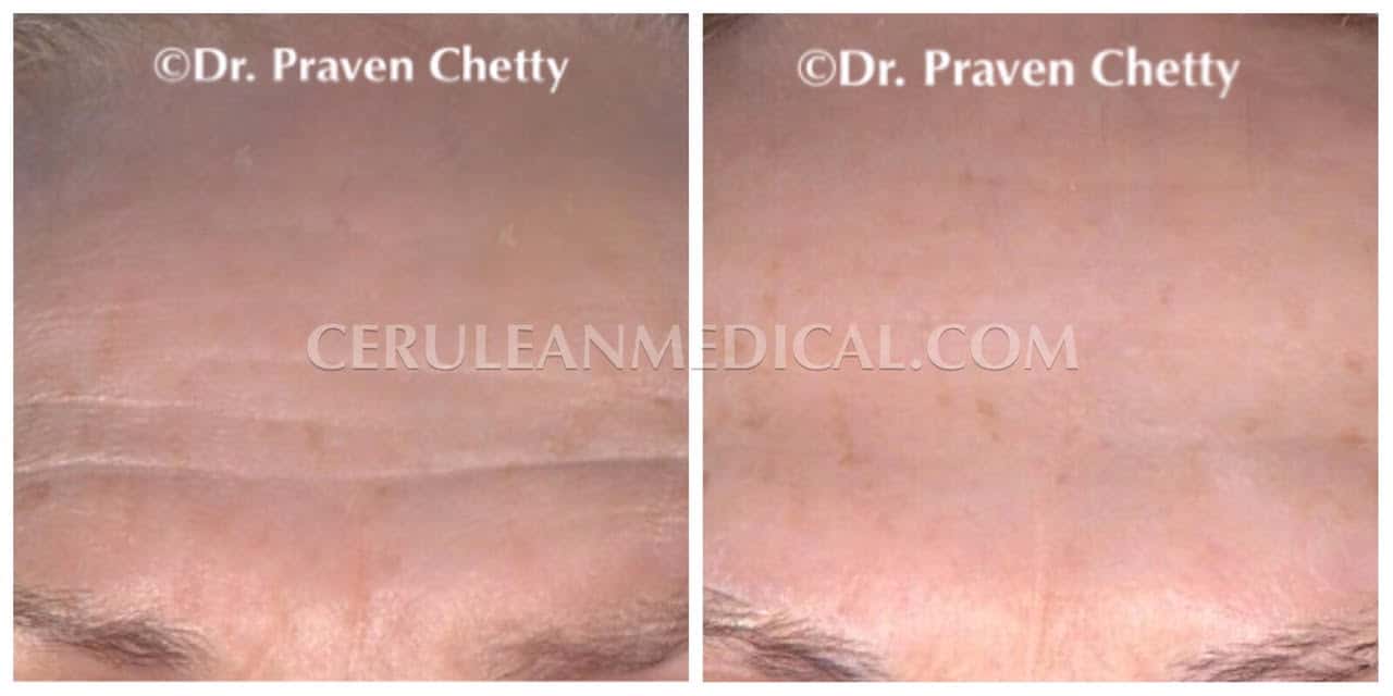 Forehead and Frown Line Botox Before and After Photo 7 at Cerulean Medical Institute in Kelowna BC