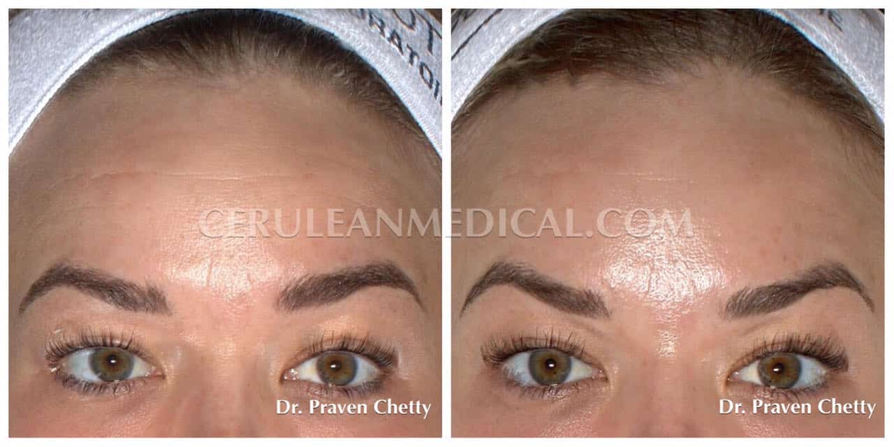 Forehead and Around the Eyes Botox Before and After Photo 3 at Cerulean Medical Institute in Kelowna BC
