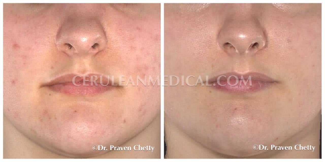 Chemical Peel Before and After Photo 1 at Cerulean Medical Institute in Kelowna BC