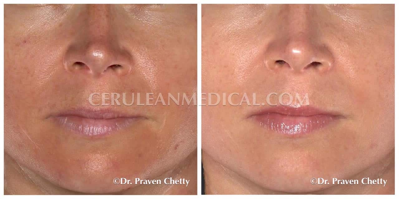 Chemical Peel Before and After Photo 2 at Cerulean Medical Institute in Kelowna BC