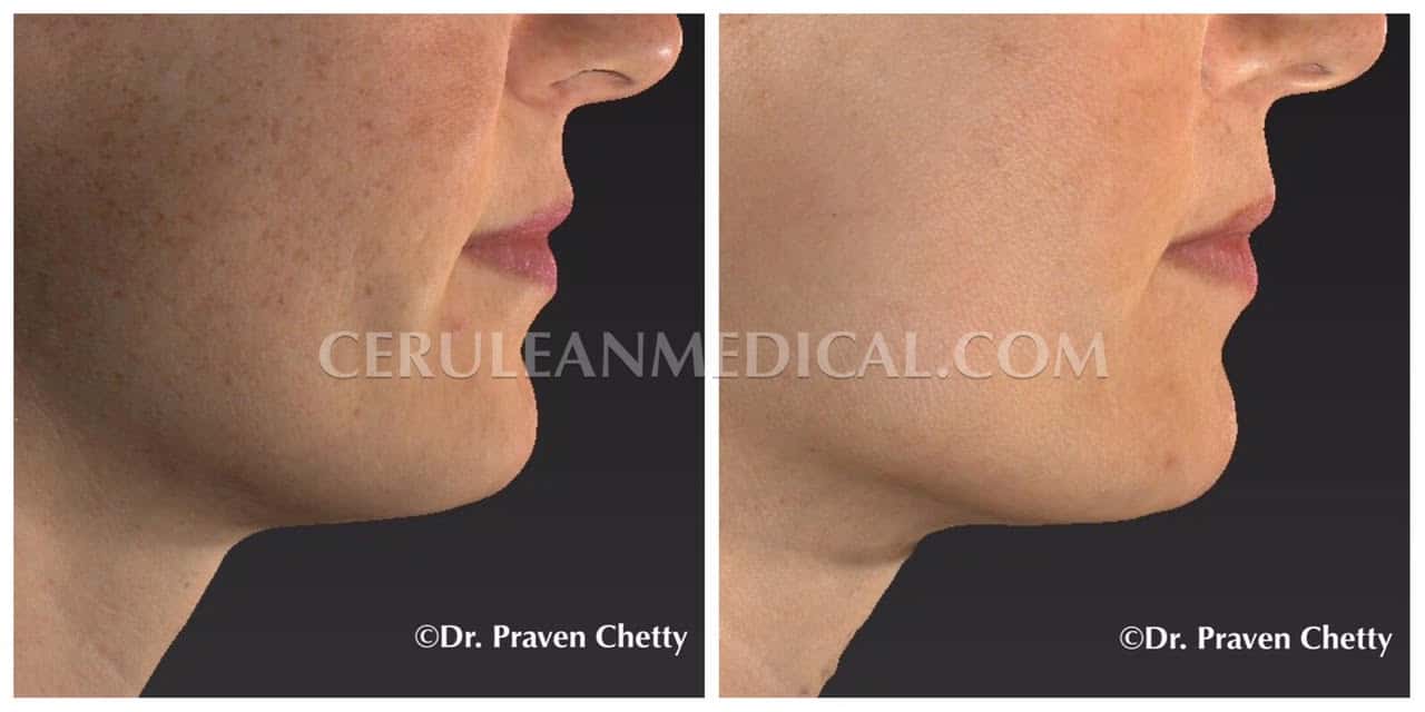IPL Before and After Photo 2 at Cerulean Medical Institute in Kelowna BC