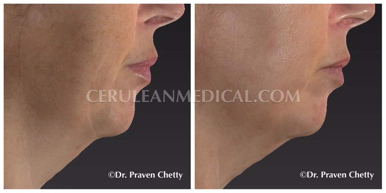 IPL Before and After Photo 1 at Cerulean Medical Institute in Kelowna BC