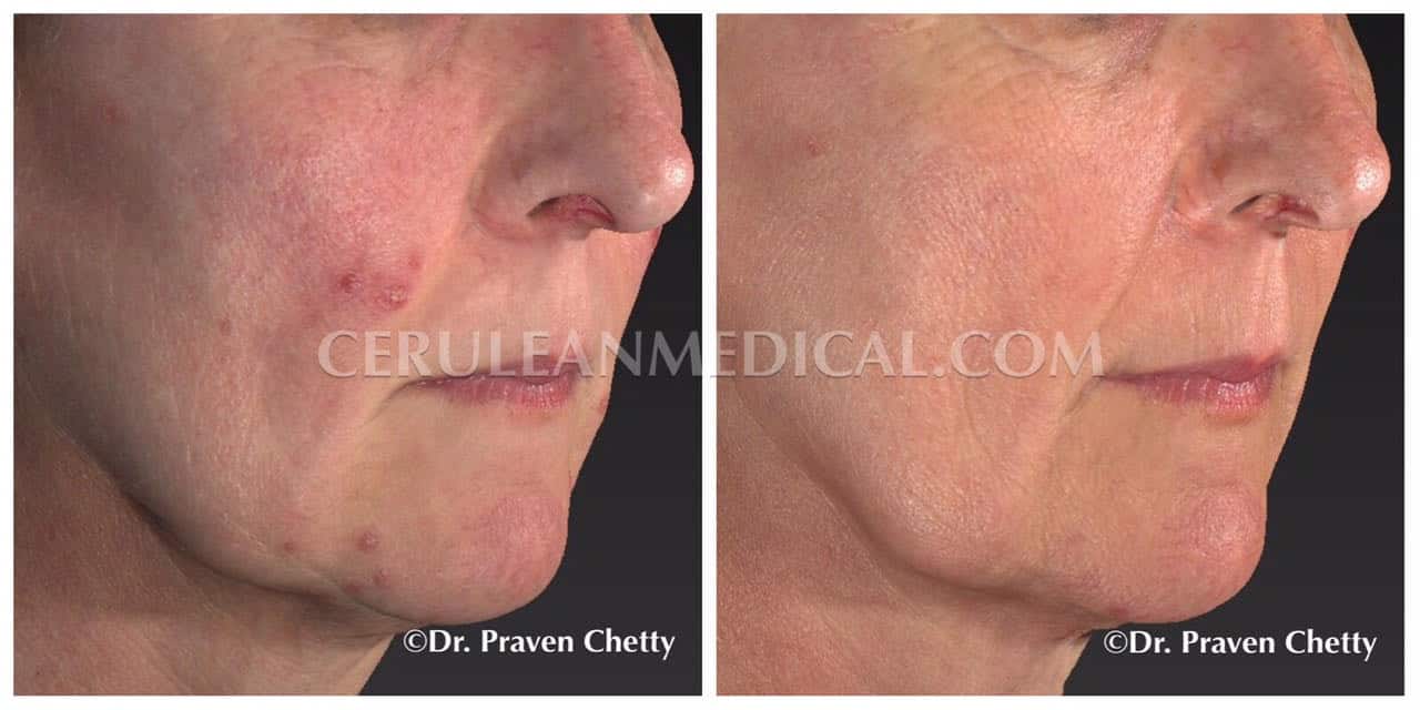 Rosacea Treatment Before and After Photo 2 at Cerulean Medical Institute in Kelowna BC