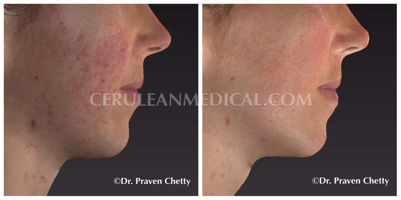 Rosacea Treatment Before and After Photo 4 At Cerulean Medical Institute in Kelowna BC