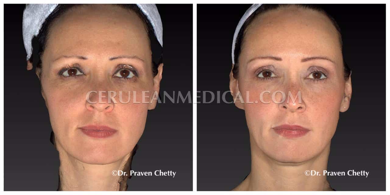 Soft Lift Before and After Photo 1 at Cerulean Medical Institute in Kelowna BC