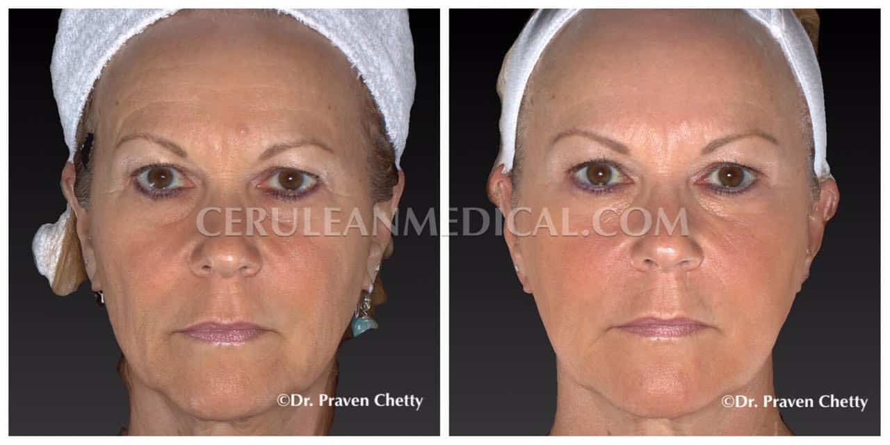 Soft Lift Before & After Photo 2 at Cerulean Medical Institute in Kelowna BC