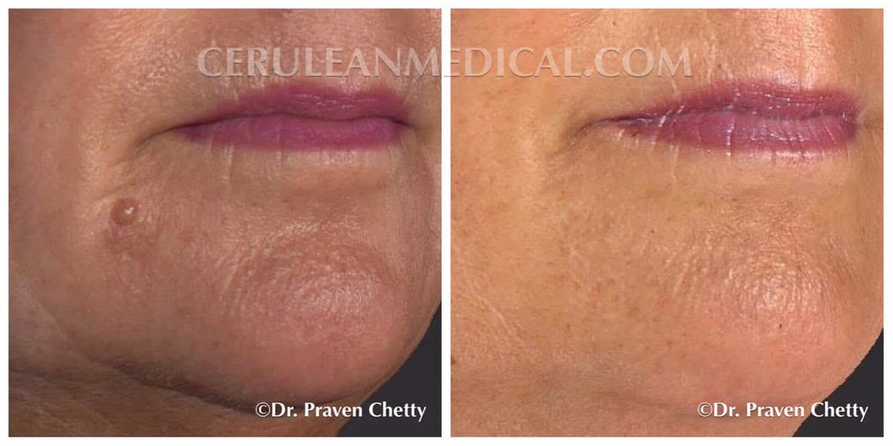 Mole Removal Before and After Photo 1a at Cerulean Medical Institute in Kelowna BC