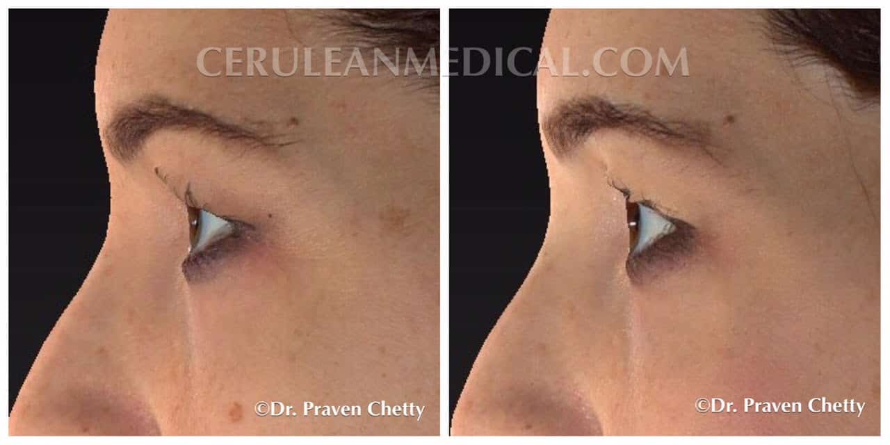 Mole Removal Before and After Photo 2a at Cerulean Medical Institute in Kelowna BC