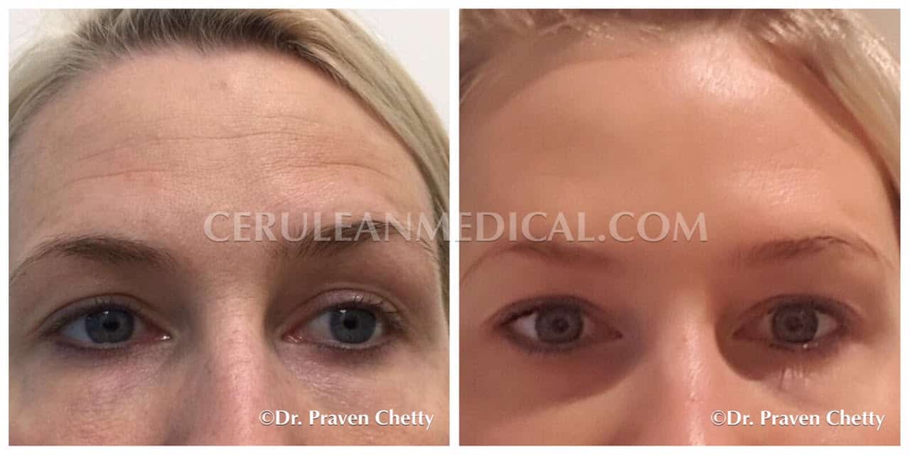 Skin Tightening Before and After Photo 5 at Cerulean Medical Institute in Kelowna BC