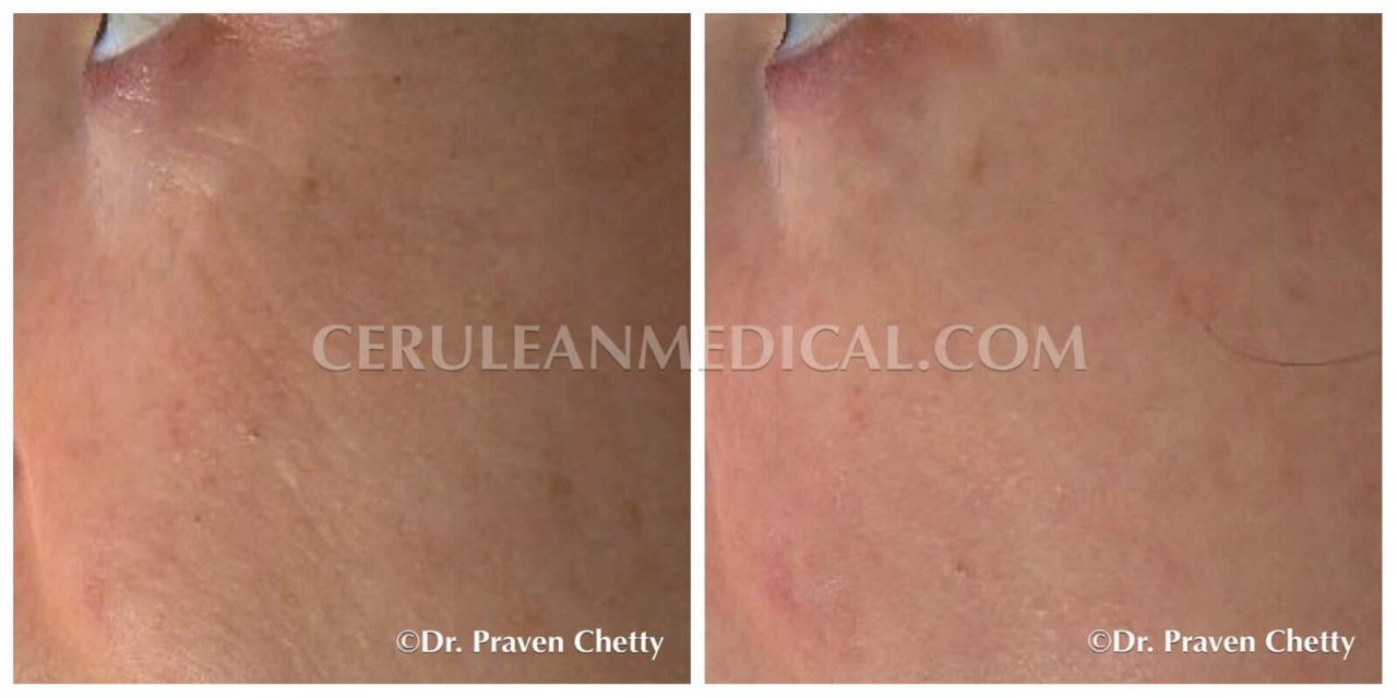 Botox for Crow's Feet Before and After Photo 9 at Cerulean Medical Institute in Kelowna BC