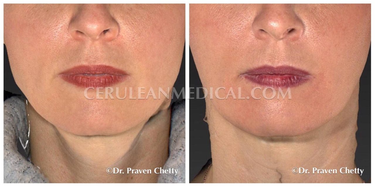 Botox Masseter Before and After Photo 10 at Cerulean Medical Institute in Kelowna BC