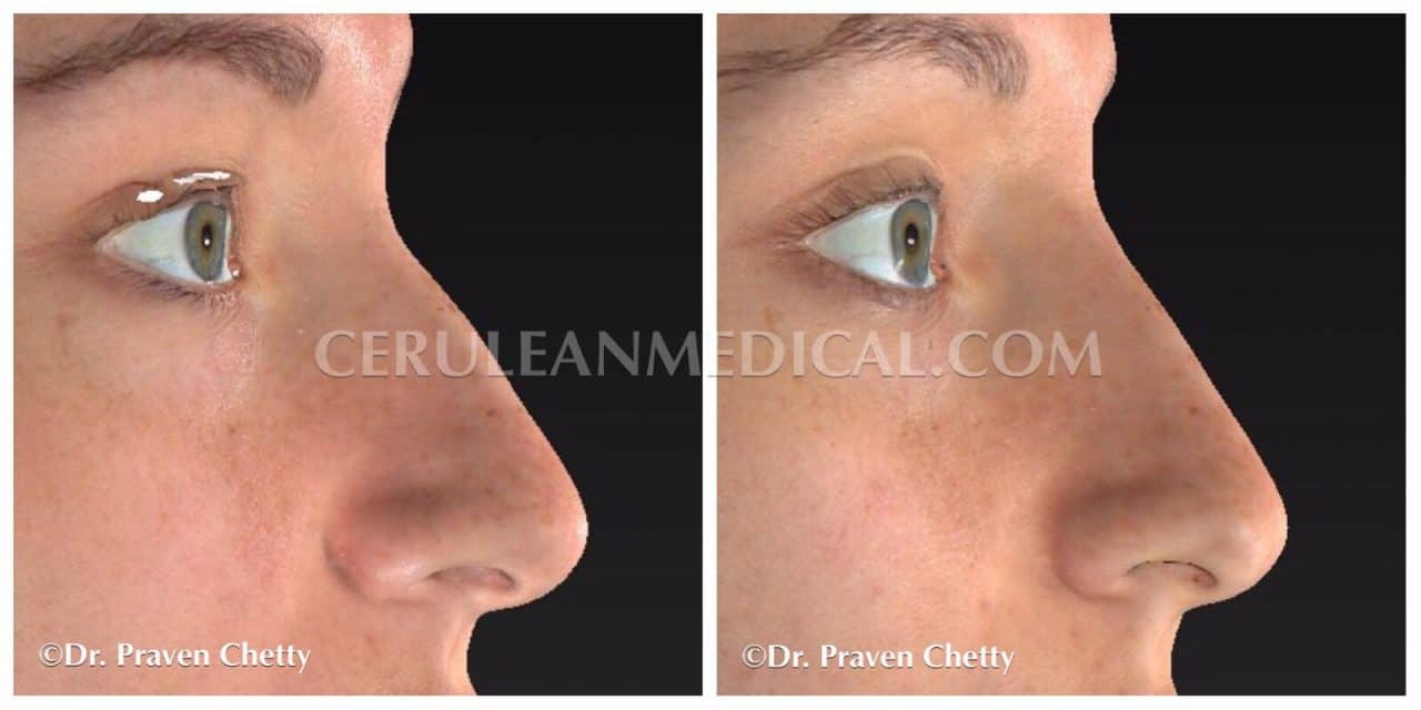 Nose Augmentation Before and After Photo at Cerulean Medical Institute in Kelowna BC