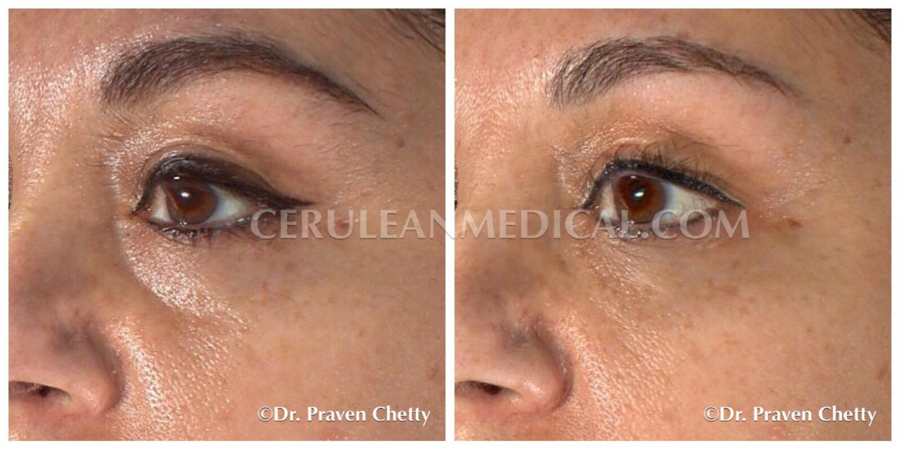 Dermal Fillers Before and After Photo 8 at Cerulean Medical Institute in Kelowna BC