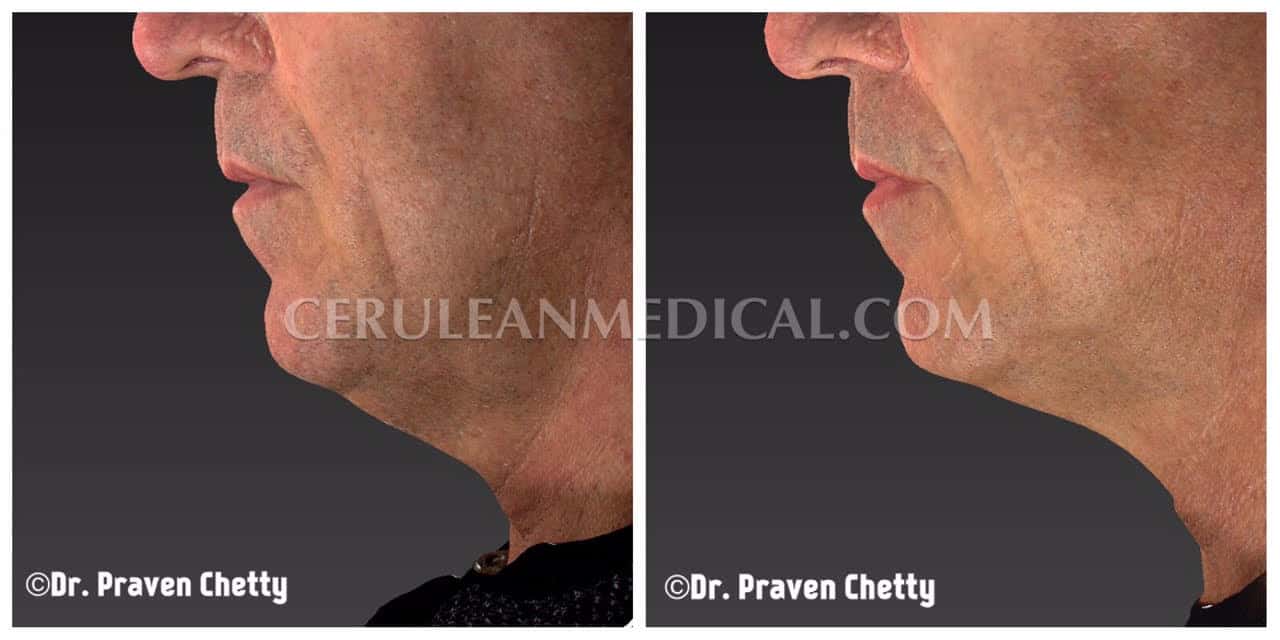 Skin Tightening Before and After Photo 7 at Cerulean Medical Institute in Kelowna BC