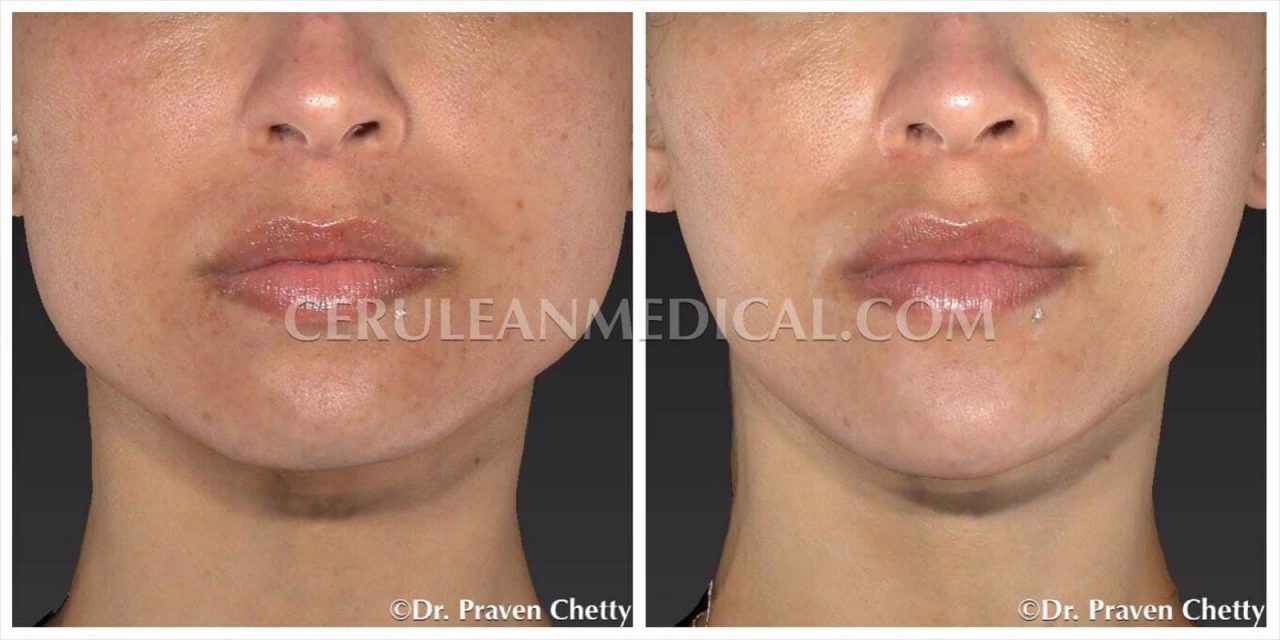Jawline slimming with Jaw Botox or Botox Masseter Before and After Photo 1 at Cerulean Medical Institute in Kelowna BC