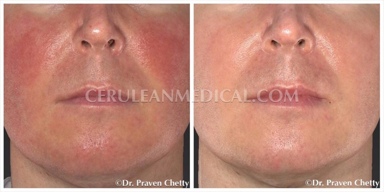 IPL Before and After Photo 5 at Cerulean Medical Institute in Kelowna BC