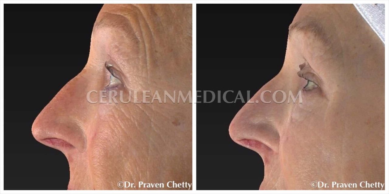 Microneedling Before and After Photo 1 at Cerulean Medical Institute in Kelowna BC