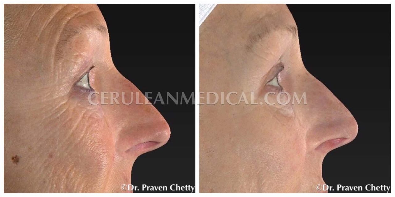 Microneedling Before and After Photo 2 at Cerulean Medical Institute in Kelowna BC