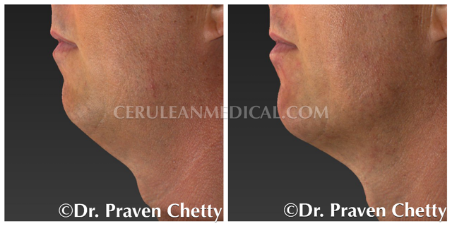 Radiesse Before and After Photo 1 at Cerulean Medical Institute in Kelowna BC
