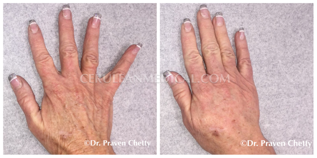 Radiesse Before and After Photo 2 at Cerulean Medical Institute in Kelowna BC