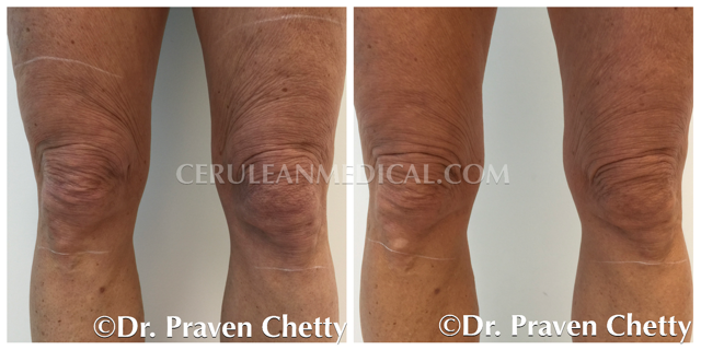 Radiesse Before and After Photo 3 at Cerulean Medical Institute in Kelowna BC