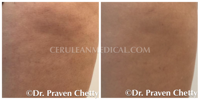 Radiesse Before and After Photo 5 at Cerulean Medical Institute in Kelowna BC