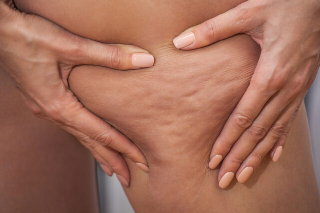 Cellulite Treatments at Cerulean Medical Institute - Kelowna BC