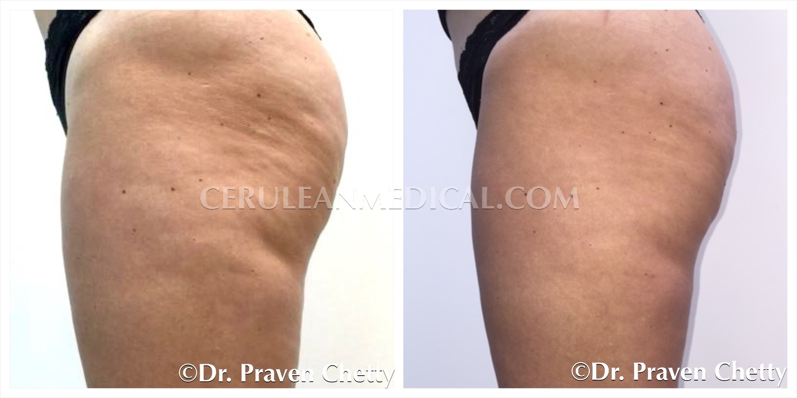 Cellulite Reduction Treatment Before and After Photo 1 at Cerulean Medical Institute in Kelowna BC