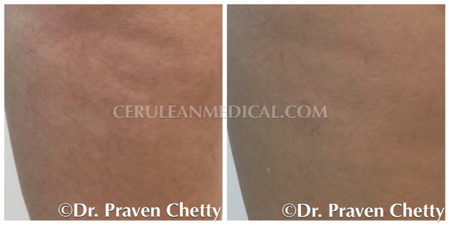 Cellulite Reduction Treatment Before and After Photo 4 at Cerulean Medical Institute in Kelowna BC